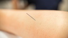 Akupunktura - na czym polega?
