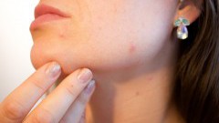 Jakie leki i inne preparaty najlepiej stosować na łuszczycę?