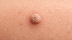 Płyn na kurzajki – skuteczne metody walki z brodawkami i wsparcie leczenia domowego