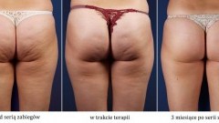 „Pomarańczowa skórka” na cenzurowanym – czyli jak szybko wygrać z cellulitem?