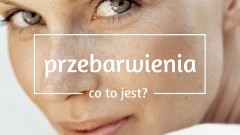 Przebarwienia - pamiątka po wakacjach