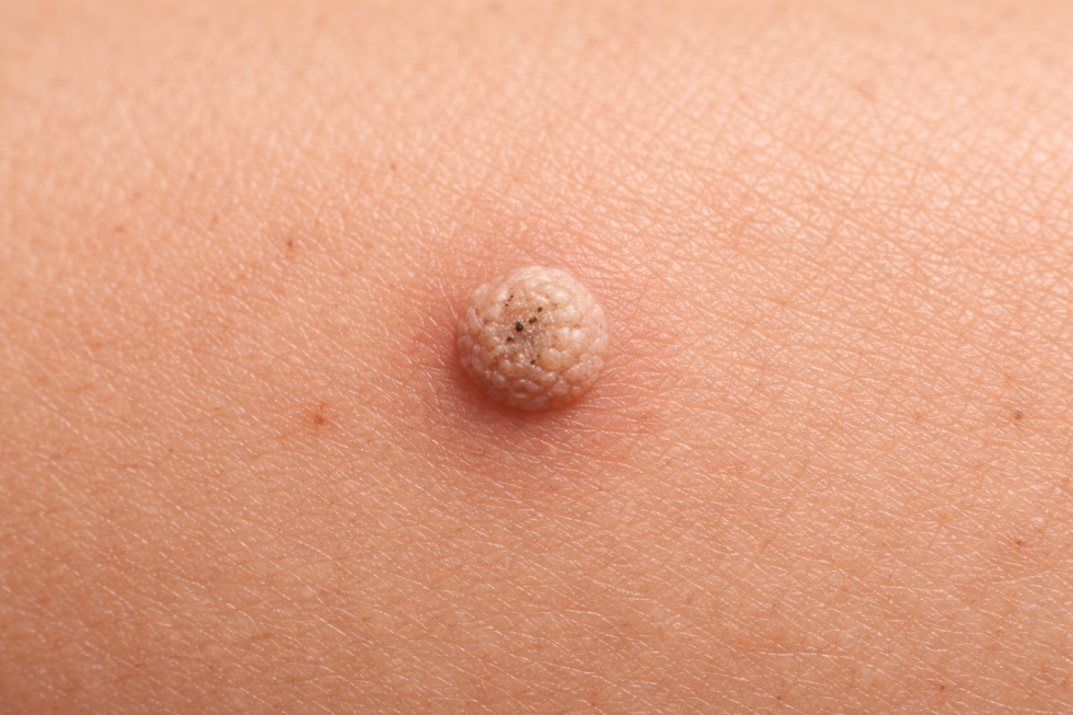 Płyn na kurzajki – skuteczne metody walki z brodawkami i wsparcie leczenia domowego