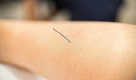 Akupunktura - na czym polega?