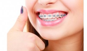 Aparat stały Damon Q - Poznaj jego zalety!