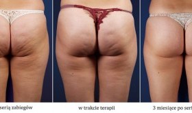 „Pomarańczowa skórka” na cenzurowanym – czyli jak szybko wygrać z cellulitem?